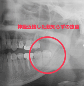 親知らず抜歯　智歯抜歯