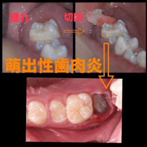 小児歯科　歯茎の腫れ