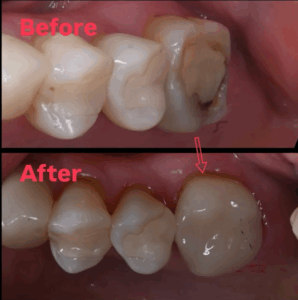 セラミック治療