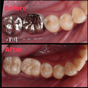 セラミック　ジルコニア