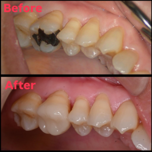 セラミック　オーバーレイ