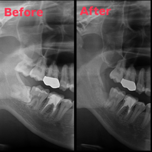 親知らず抜歯　智歯抜歯