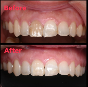 ホワイトニング　ウォーキングブリーチ