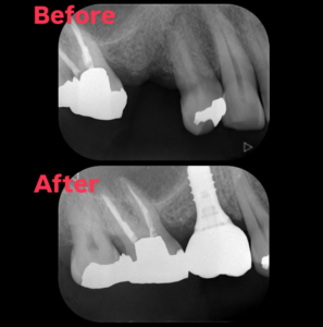 インプラント　経過良好