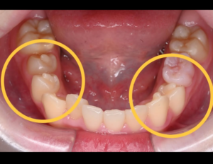 小児　中心結節