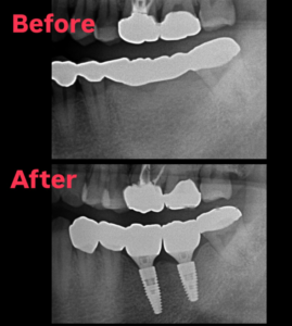 インプラント　ブリッジ