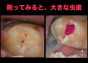 虫歯　小窩裂溝　う蝕　