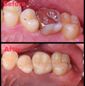セラミック　ジルコニア