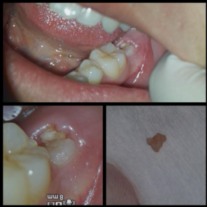 萌出性腐骨　小児