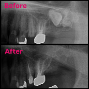 親知らず　智歯　抜歯　歯牙種